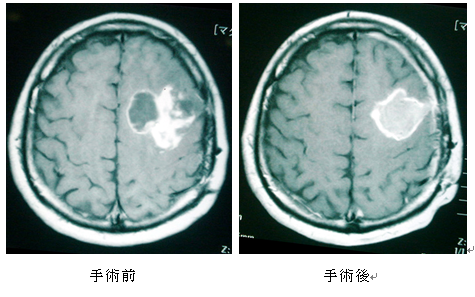 小児における脳腫瘍の最も一般的な種類は何ですか?
