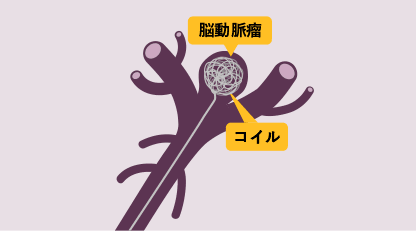 脳動脈瘤 図2