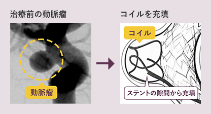 手術前 治療後 図