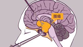 難治性下垂体腫瘍の開頭・経鼻内視鏡同時手術