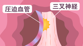 三叉神経痛・片側顔面けいれん