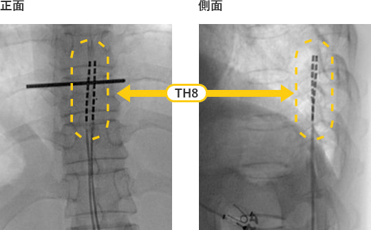 脊髄刺激療法に使用する機材例2