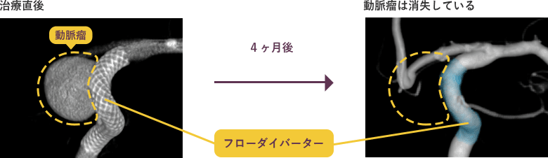 手術直後に動脈瘤が消失している