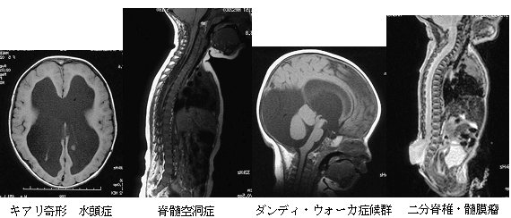 その他の疾患】先天性水頭症｜脳の病気｜福岡脳神経外科病院｜医療法人