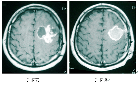 脳腫瘍 脳腫瘍】神経膠腫（グリオーマ）｜脳の病気｜福岡脳神経外科病院｜医療