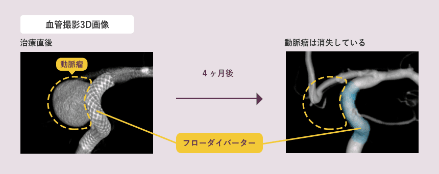 フローダイバーター治療例