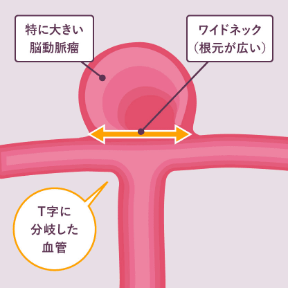 血管分岐部の脳動脈瘤