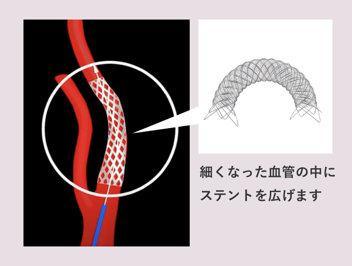 細くなった血管の中にステントを広げます