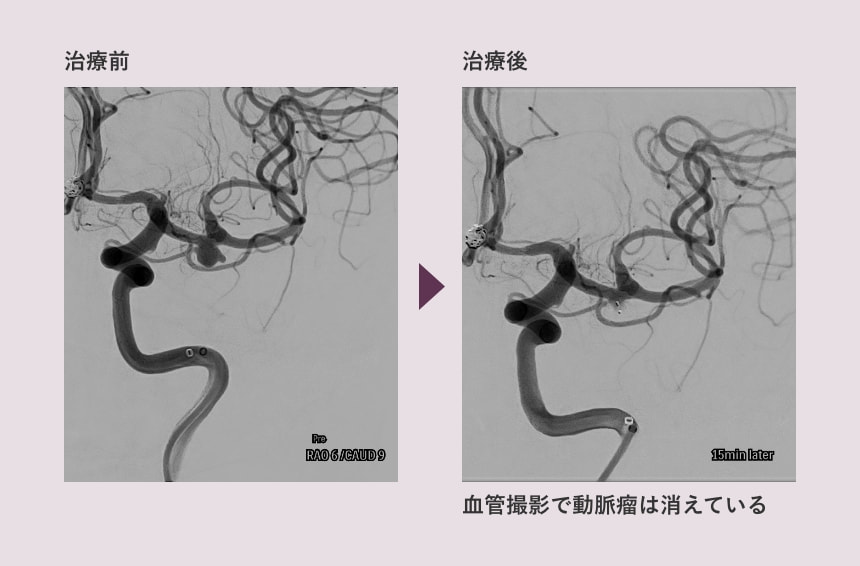 WEB治療例