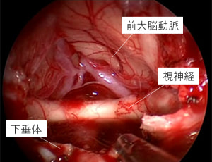 腫瘍摘出後
