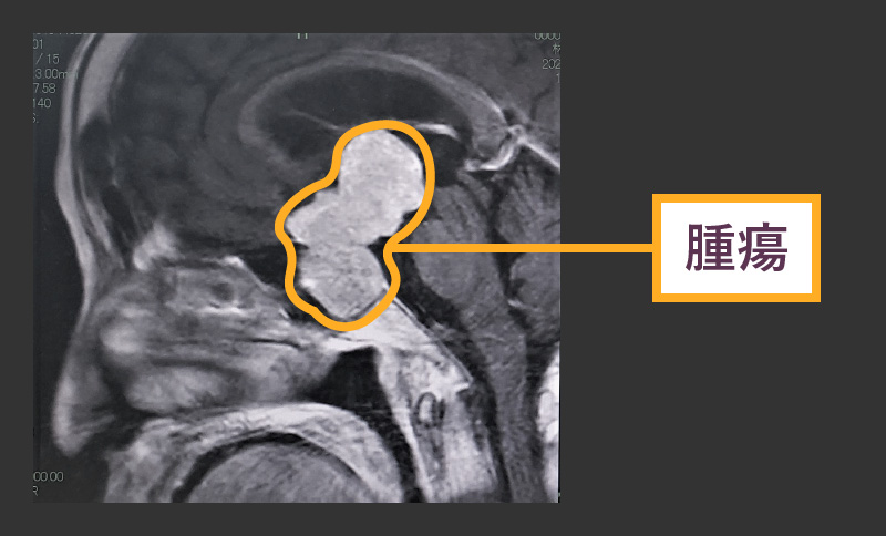 下垂体腫瘍