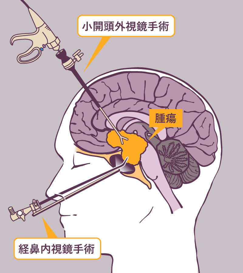 小開頭手術＋経鼻内視鏡手術