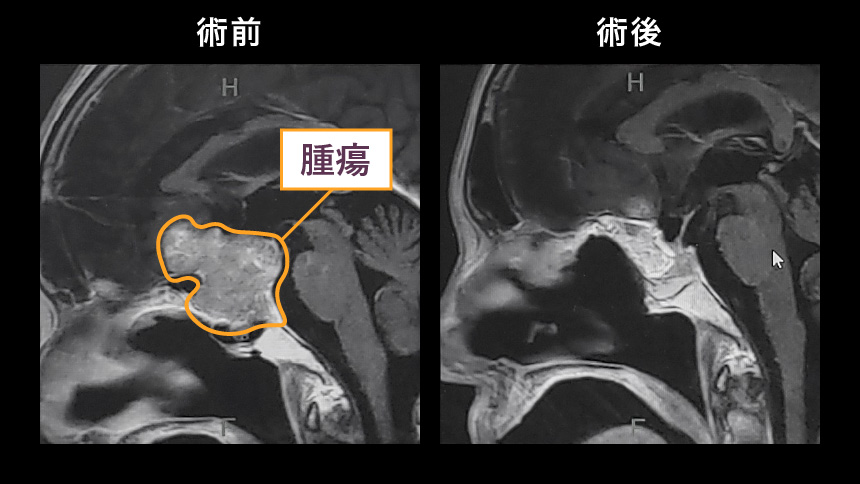 小開頭手術＋経鼻内視鏡手術