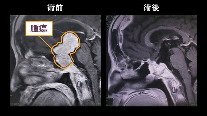 穿頭経脳室内視鏡手術＋経鼻内視鏡手術