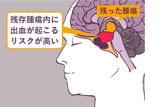残存腫瘍内に出血が起こるリスク
