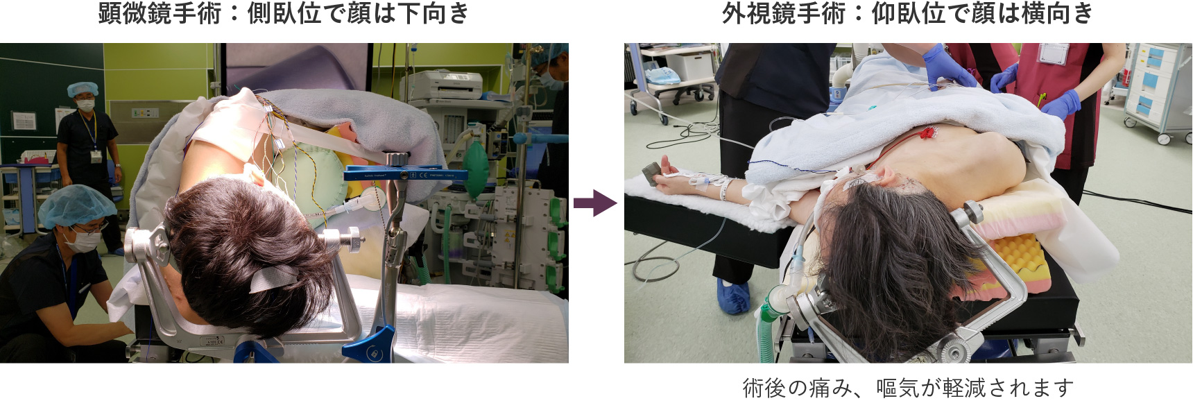 外視鏡（ORBEYE®）導入による手術体位の変化