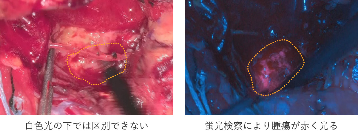 ORBEYE下での蛍光観察による腫瘍摘出