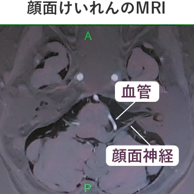 顔面けいれんのMRI