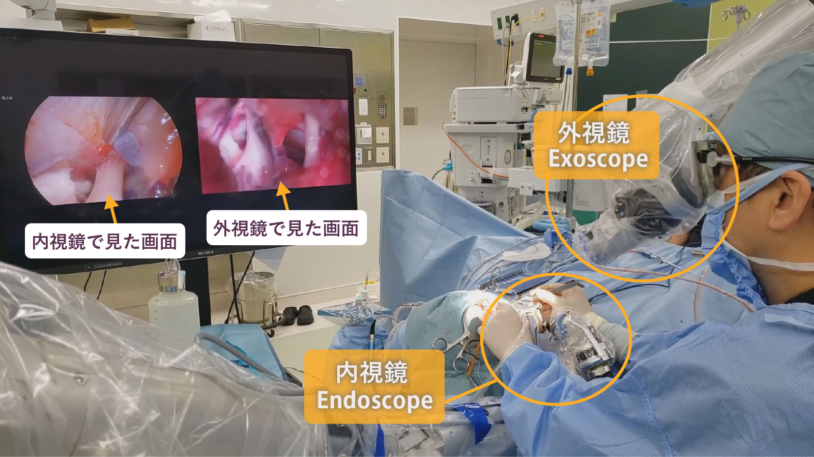 外視鏡と内視鏡を用いた神経血管減圧術
