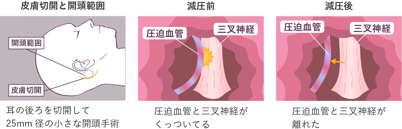 神経血管減圧術
